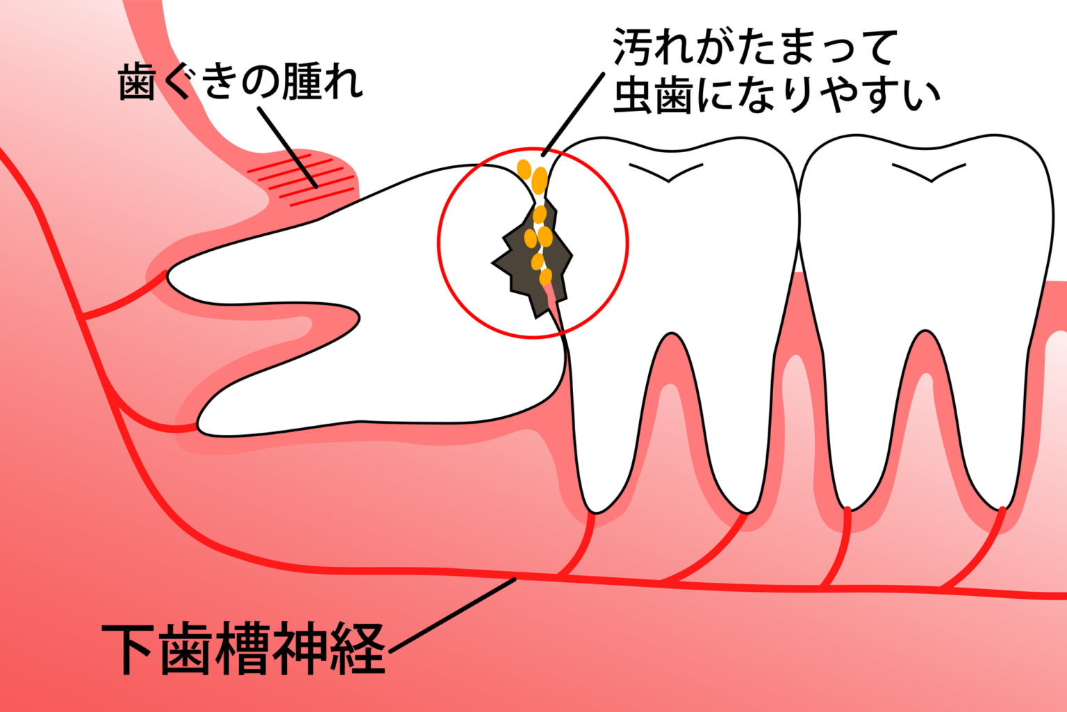 西中島南方駅徒歩1分の歯医者、海野歯科クリニックの、親知らずの抜歯