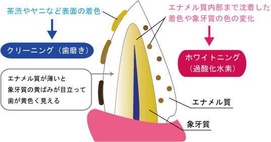 西中島南方駅徒歩1分の歯医者、海野歯科クリニックの、ホワイトニング